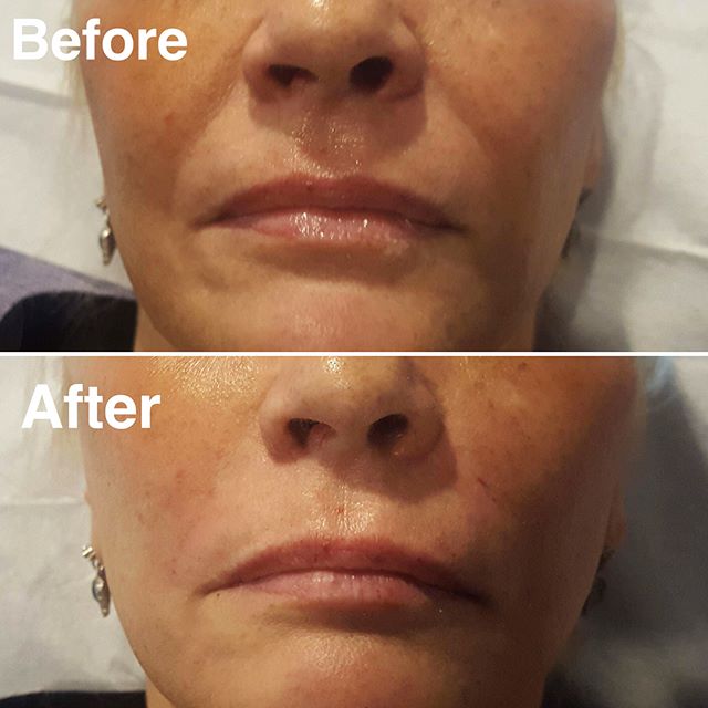 nasolabial folds dermal fillers