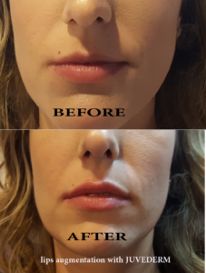 lips augmentation with Juvederm - before and after