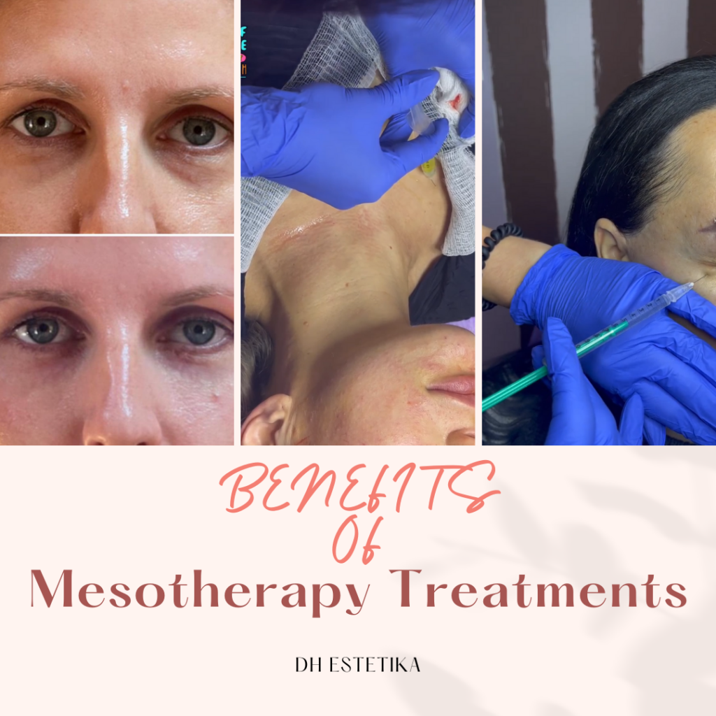 Benefits of Mesotherapy Treatments