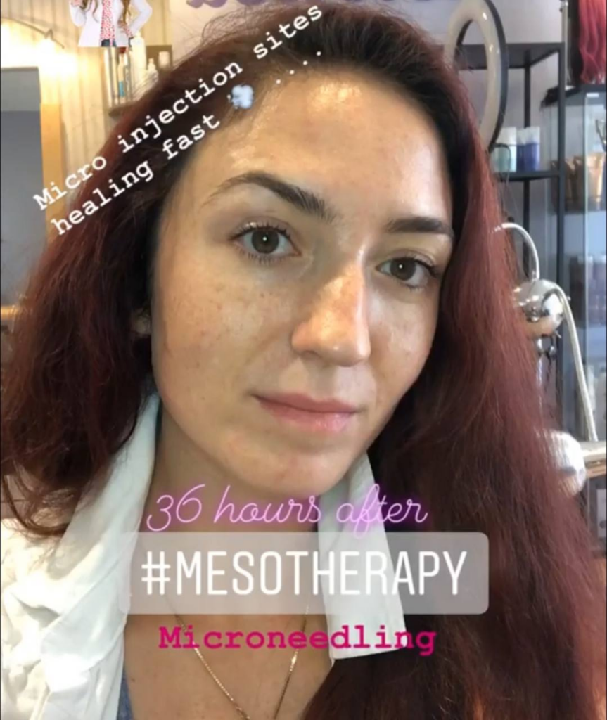 Darya Heras - Mesotherapy - Microneedling healing fast